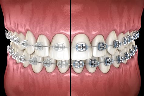 metal brackets vs ceramic brackets|traditional metal braces vs ceramic.